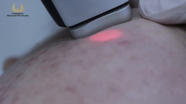 Удаление красных пятен постакне лазером