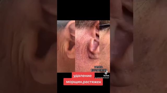 плазмалифт удаление морщин, растяжек