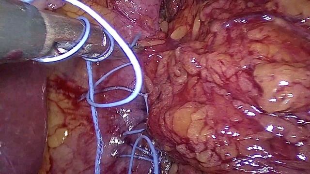 Хирургическое лечение грыжи пищеводного отверстия диафрагмы
