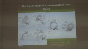 Ревизионное эндопротезирование - решение для вертлужного компонента