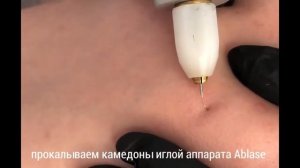 Как убрать камедоны не выдавливая?