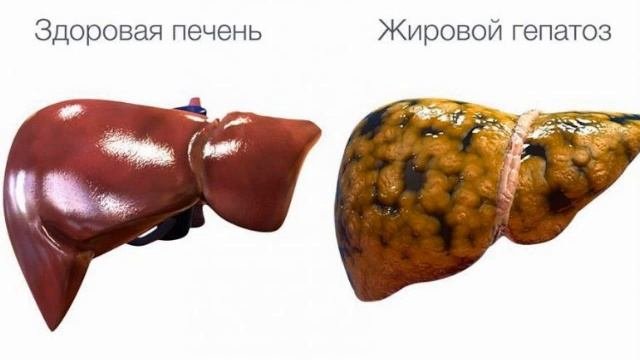 Это важно! Последствия лишнего веса