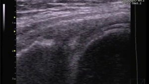 Повреждение заднего рога медиального мениска в сравнении с контрлатеральным мениском.