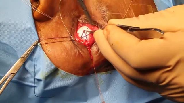 Dr. Khan Bioceramic Orbit Implant смотреть онлайн