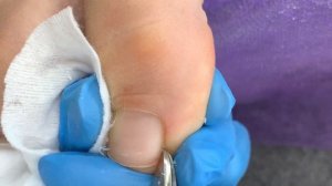 Преображение, ОКОЛОНОГТЕВАЯ МОЗОЛЬ, сложный педикюр