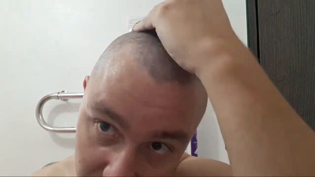 Псориаз. Очень сильное обострение! смотреть онлайн