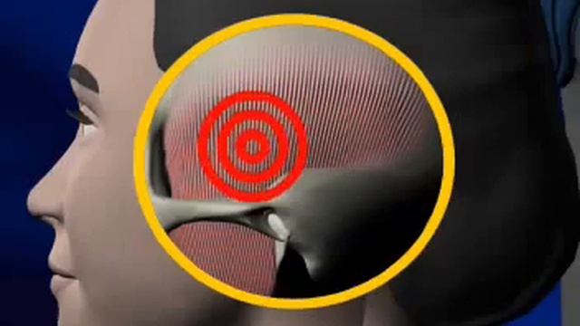 Бруксизм смотреть онлайн