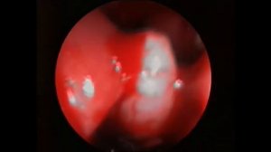 Пластика перфорации перегородки носа на питающей ножке