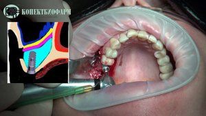 Открытый синус-лифтинг с одномоментной имплантацией