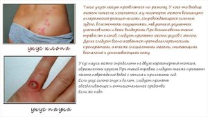 Эти Укусы Насекомых нужно УМЕТЬ РАСПОЗНАТЬ! Что делать при укусе?