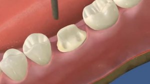 Культевая вкладка и последующая коронка на 36 - ДокторСтом Краснодар