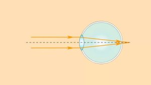 Коррекция дальнозоркости