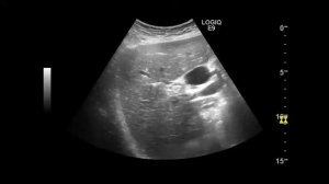 дренирование  желчного протока