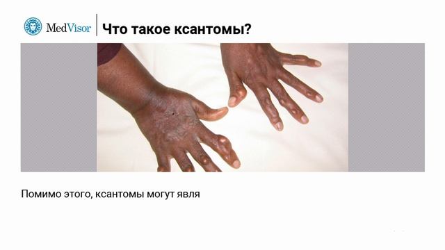 У меня желтые наросты на коже. На что они указывают? смотреть онлайн