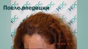 Женская пересадка волос. Клиника HDC