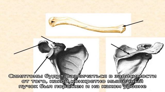 Плечевое сплетение