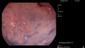 Клинический случай диагностики раннего рака желудка