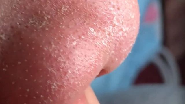 Прыщи / Огромные прыщи / Релакс с акне / Выдавливание прыщей / Черная точка #Прыщи смотреть онлайн