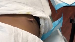 Удаляем гной на коже