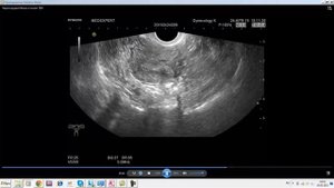 Эхосемиотика структурных изменений органов малого таза. Часть 2