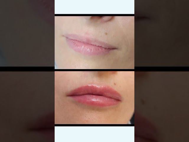 Увеличение губ - это больно? Какой препарат выбрать? И другие вопросы смотреть онлайн