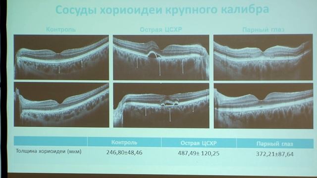 Cателлитный симпозиум «ОКТ-ангиография: вчера, сегодня, завтра».Докладчик Светлана Ивановна Жукова смотреть онлайн