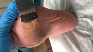Callus removal from feet&Foot scraping dead skin【Xiao Yan pedicure】#stress 17
