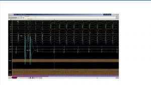 Желудочковые нарушения ритма сердца при структурно нормальном сердце