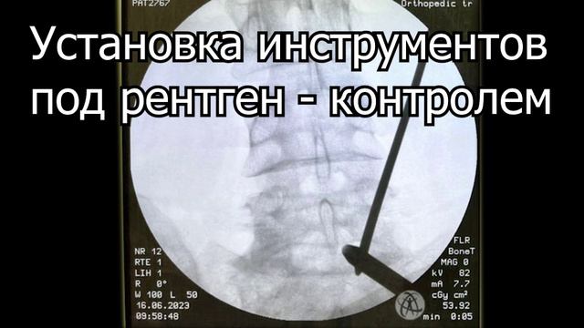 UBESS L5-S1 смотреть онлайн