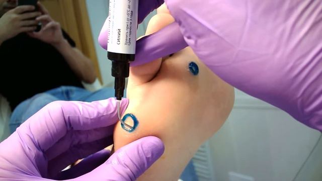 Обработка бородавки в кабинете подолога смотреть онлайн