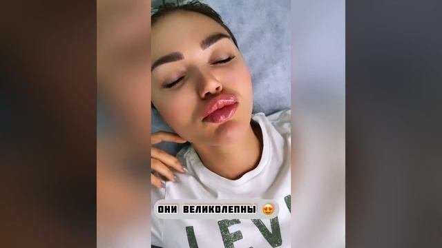 Филлер Stylage M. Какой выбрать филлер для увеличения губ. Как делают увеличение губ филлером.