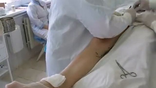 Эндовенозная лазерная коагуляция / EVLT with DIOLAN & "ring" fiber смотреть онлайн