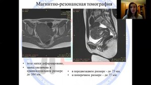 Клинический случай аденомиоза матки в практике лучевой диагностики