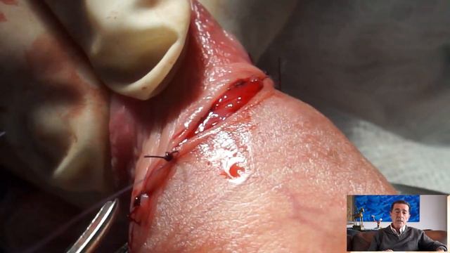 Alargamiento y engrosamiento de pene con el Dr. Cos Calvet. Tercera Parte смотреть онлайн