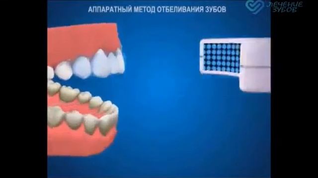 Отбеливание зубов аппаратом - лечение зубов