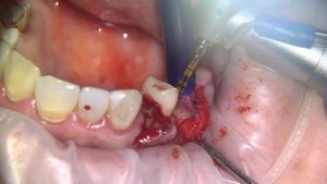 Открытый синус лифтинг септа и имплантация все в один раз