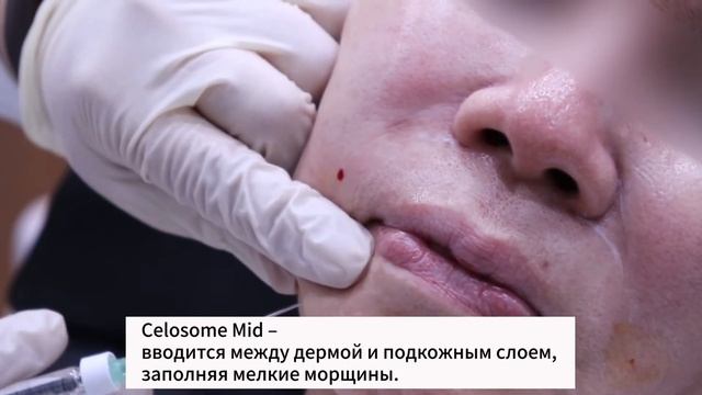 Техника инъекционной мезотерапии носогубной складки при помощи филлера Celosome