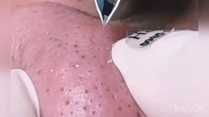 Выдавливание черных точек новое