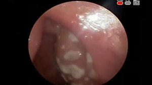 #АНГИНА #ТОНЗИЛЛИТ ГНОЙНЫЙ ДИАГНОСТИКА И ЛЕЧЕНИЕ В ПЕРИОД ANTI #COVID-19