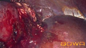 Лапароскопическая резекция правой почки с опухолью