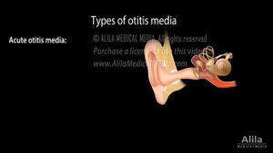 Otitis Media: Anatomy, Pathophysiology, Risk Factors, Types of OM, Symptoms and Treatment, Animatio