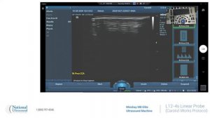 Mindray M8 Elite Carotid iWorks Protocol Training Video