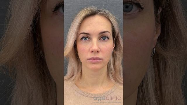 Профессиональный Hifu Лица И Щеки Подъема Машины - Buy Hifu Лицо И Щек Машины Pr