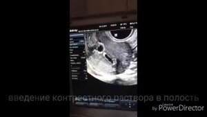Эхогистеросальпингография