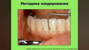 2. Оценка состояния тканей пародонта