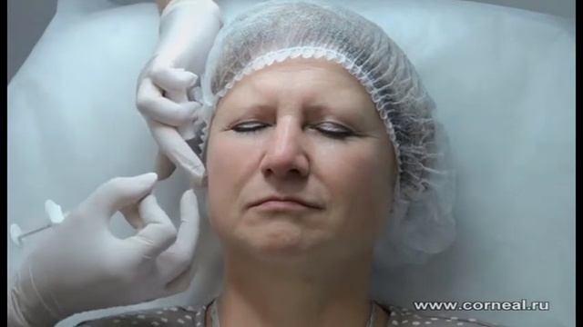 Коррекция верхней трети канюлей смотреть онлайн