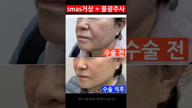 smas거상 + 물광주사 시술 한달차 후기 #리프팅 #스마스리프팅 #얼굴처짐 #facelifts  #shorts #모즈클리닉 *모든 시술/수술은 부작용이 있을 수 있습니다