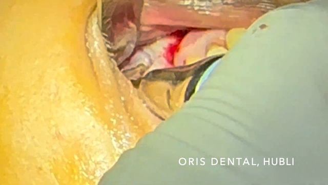 SINUS GRAFT NB MORSEL смотреть онлайн