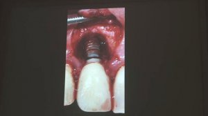 Периимплантит Часть 12. Ростов-на-Дону 2020