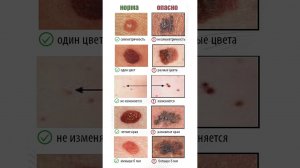 Какие образования на коже опасны #академияздоровья